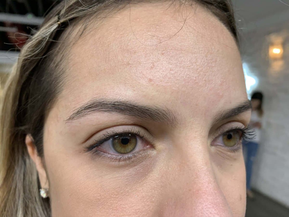 Brow healing - Before