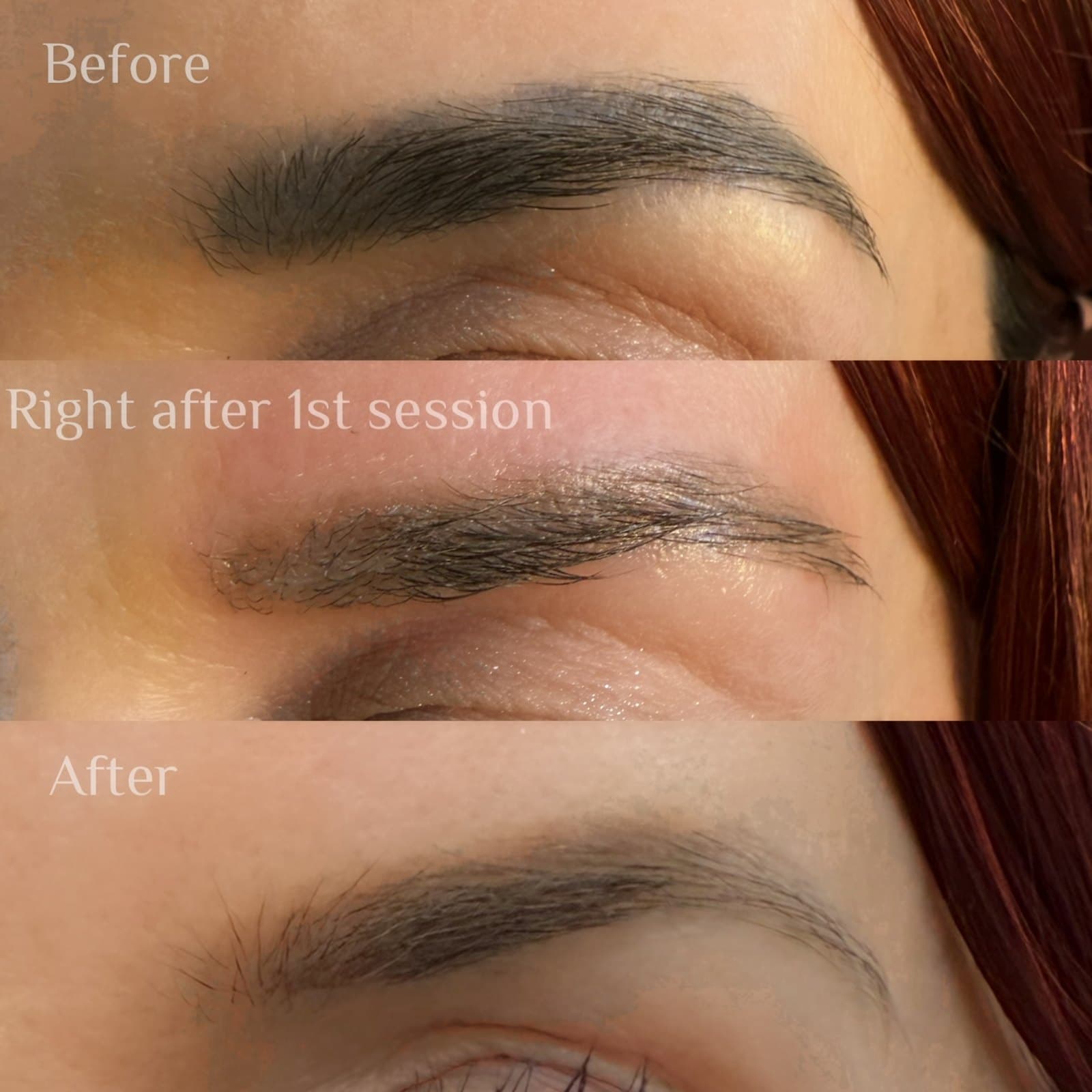 Laser brow tattoo removal — before, right after the first session, and after