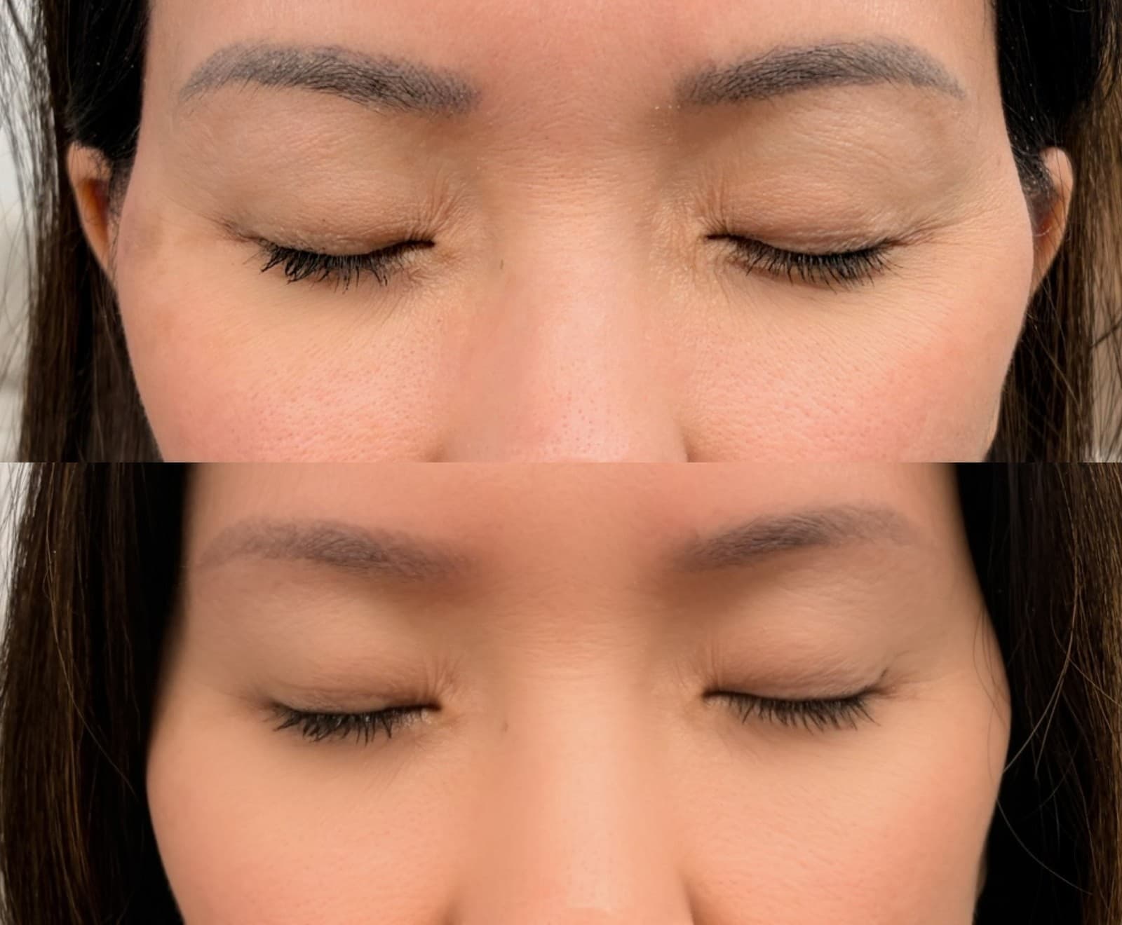 Laser brow tattoo removal before and after — dark gray brow tattoo on top, faded brows below