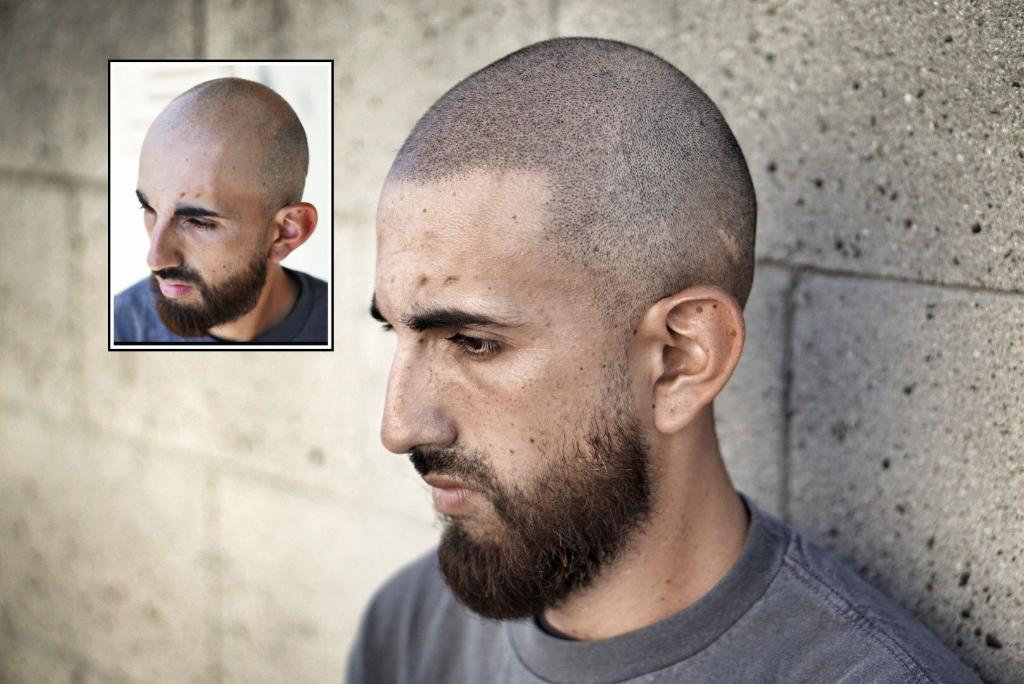 INTERVIEW: LINDSEY TA AND SCALP MICROPIGMENTATION BLOG