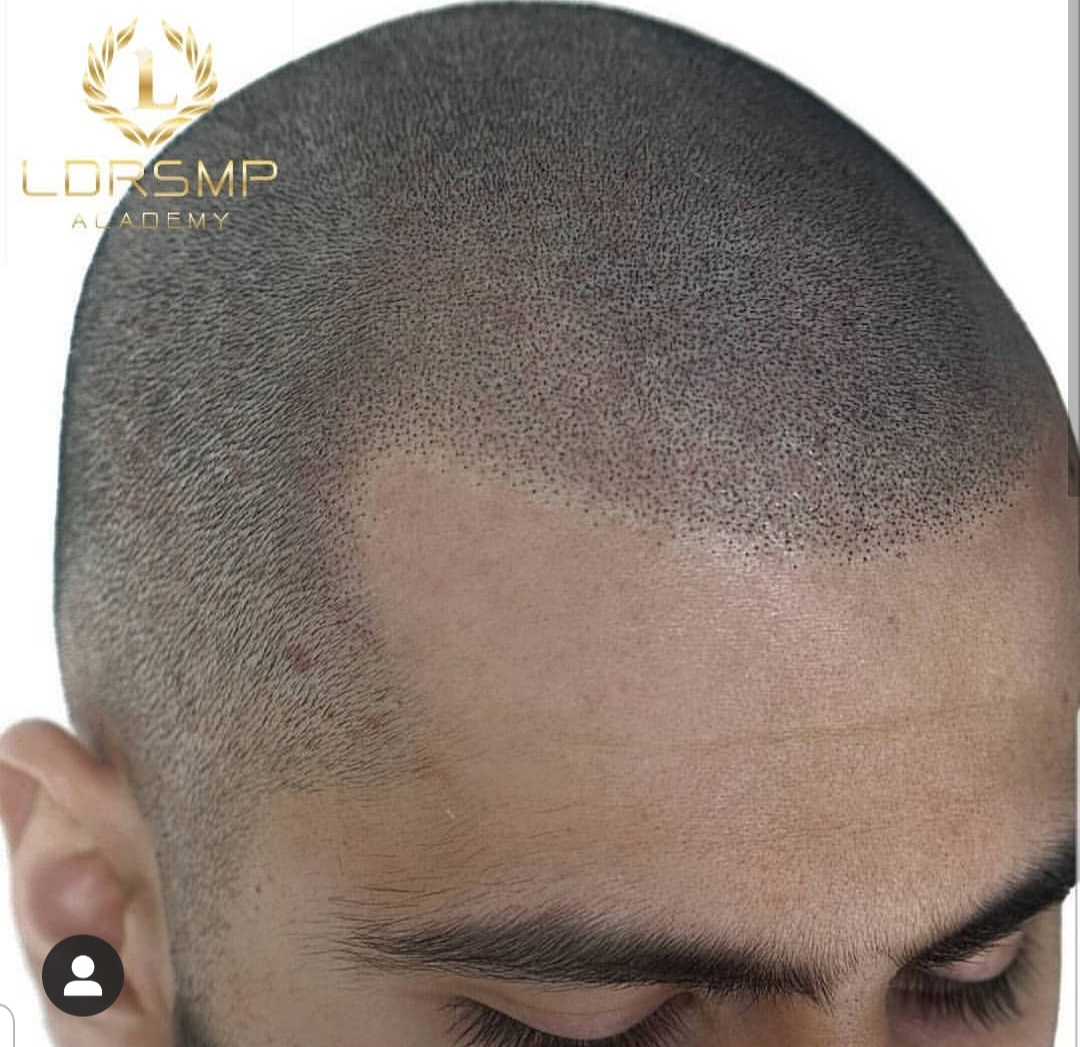 Scalp Micropigmentation Smp Training Microblading La Studio Academy Los Angeles Ca