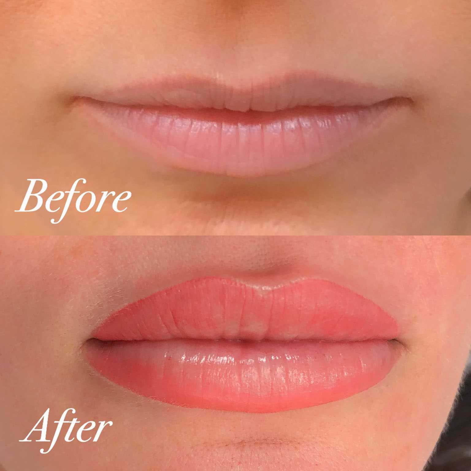 Lip Correction,Lip contour,Lip Blush