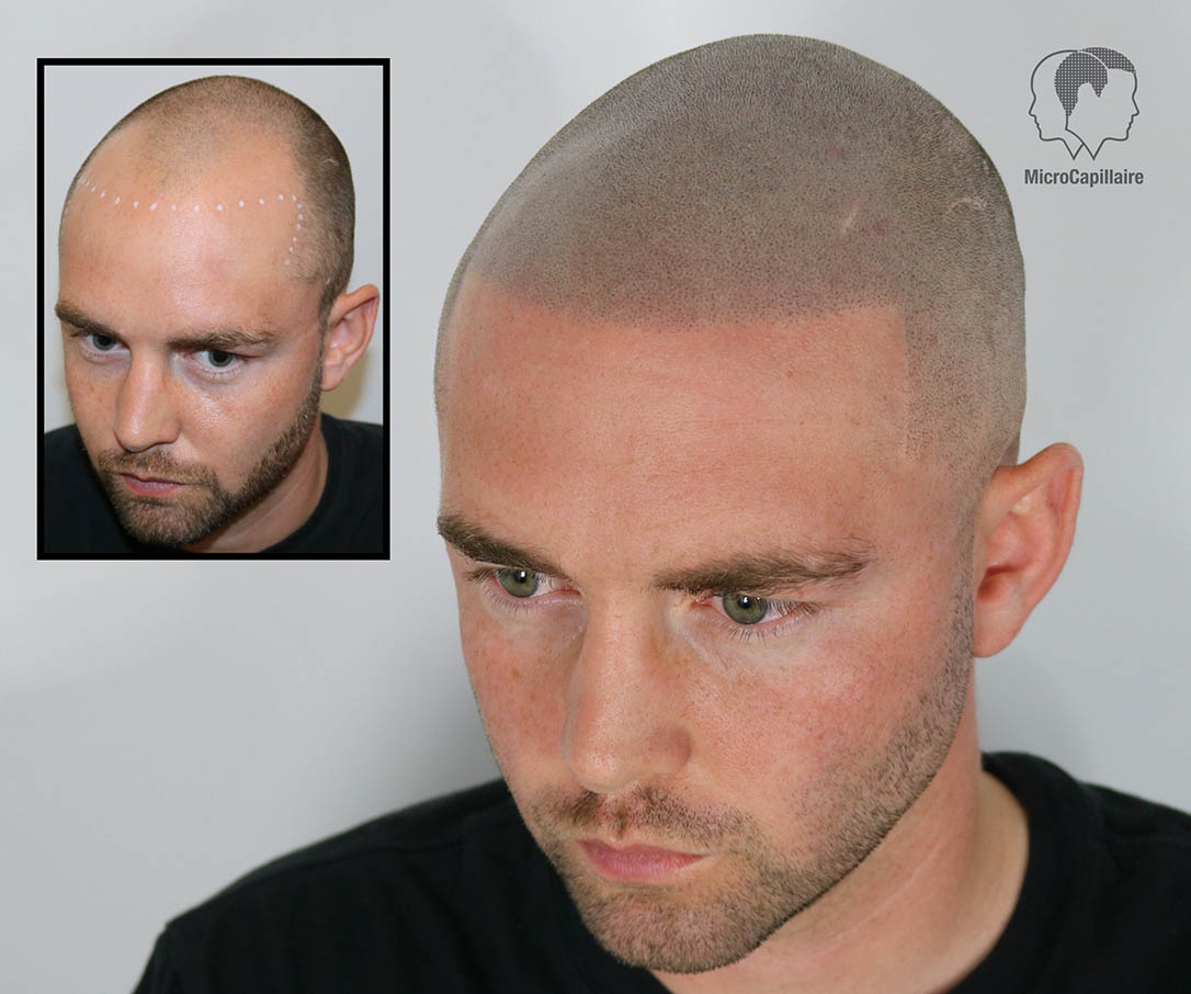 Scalp Artist International  Scalp Pigmentation Tattoos  More