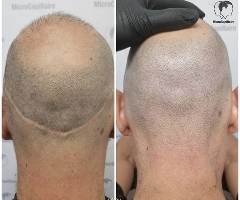 Scalp Micropigmentation (SMP) Training | Microblading LA Studio