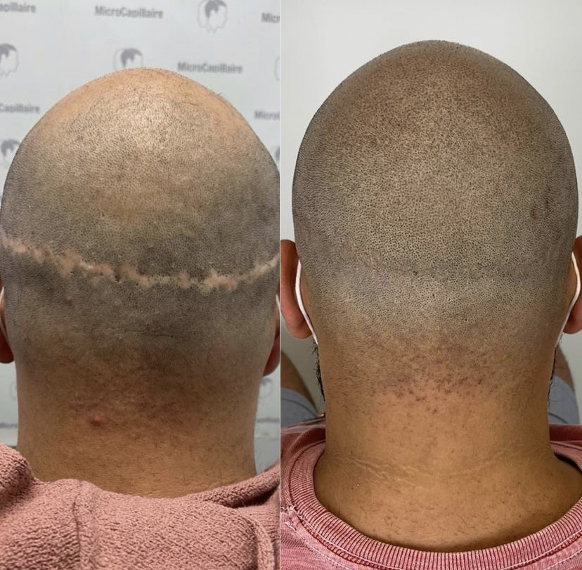 Can My Tattoo Artist Do Scalp Micropigmentation SMP  Scalp King