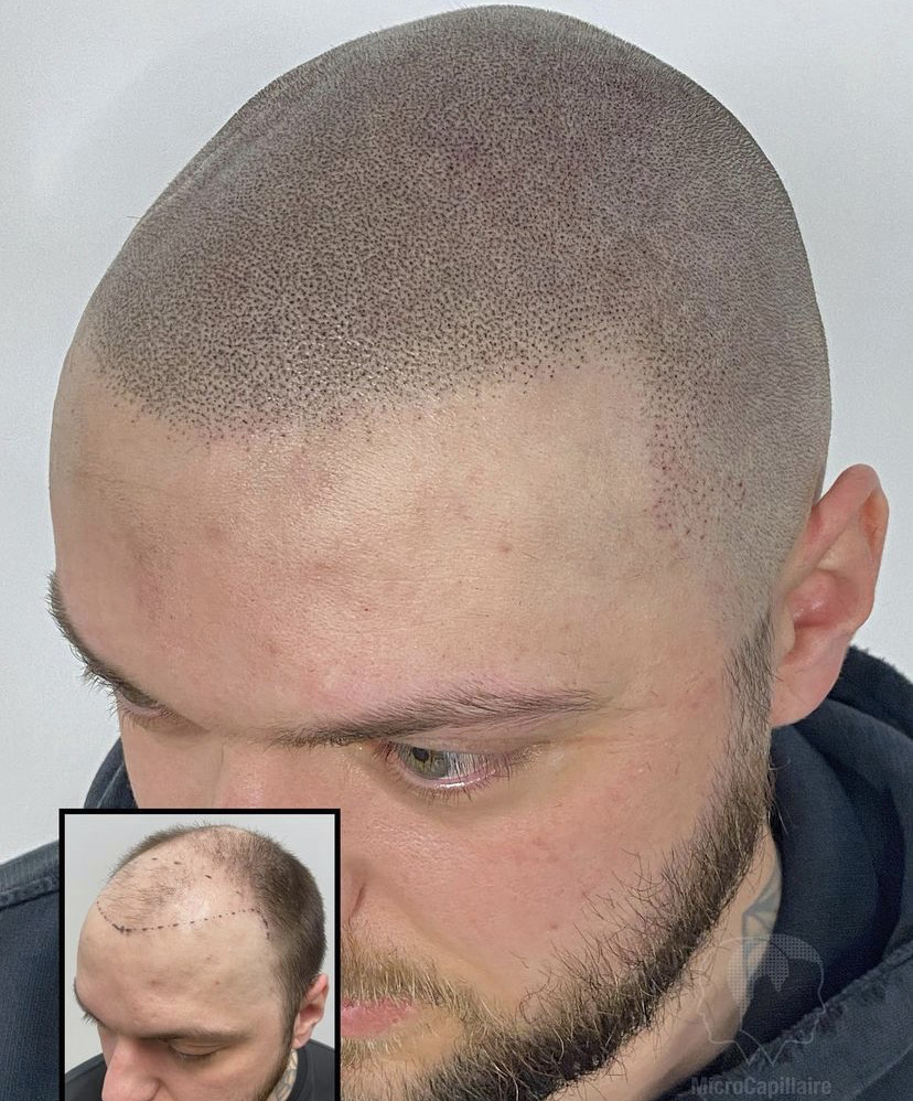 scalp micropigmentation classes near me