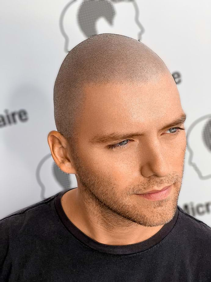 Hair Tatto For Receding Hairline